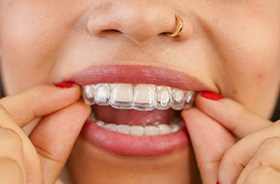 Close-up of person placing Invisalign aligner on her teeth