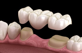 Illustration of dental bridge being placed on abutment teeth