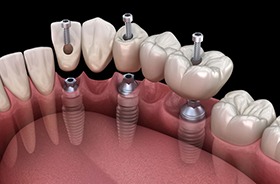 Illustration of 5-tooth dental implant bridge