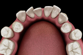 Illustration of crowded teeth viewed from above