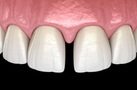 Illustration of a gap between two front teeth