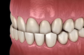 Illustration of an underbite pictured against dark background