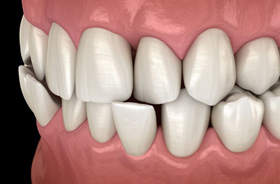 Close-up illustration of a crossbite