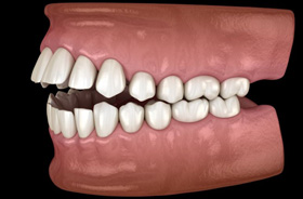 Illustration of an open bite viewed from the side