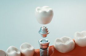 Closeup of restoration for single tooth dental implant in Branford