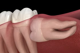 Image of a wisdom tooth below the gum line