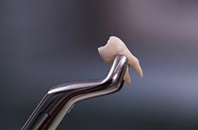 Tooth gripped in forceps after extraction
