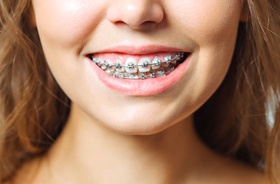 close-up of young woman’s smile with braces in Branford