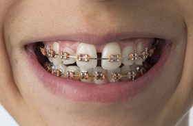 Traditional Braces Branford | Orthodontics | New Haven Dental Group