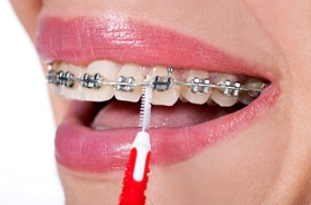 Close-up of woman’s mouth as she cleans beneath braces’ arch wire