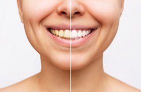 Woman’s smile before and after teeth whitening treatment
