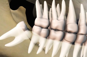 Illustration of impacted wisdom tooth