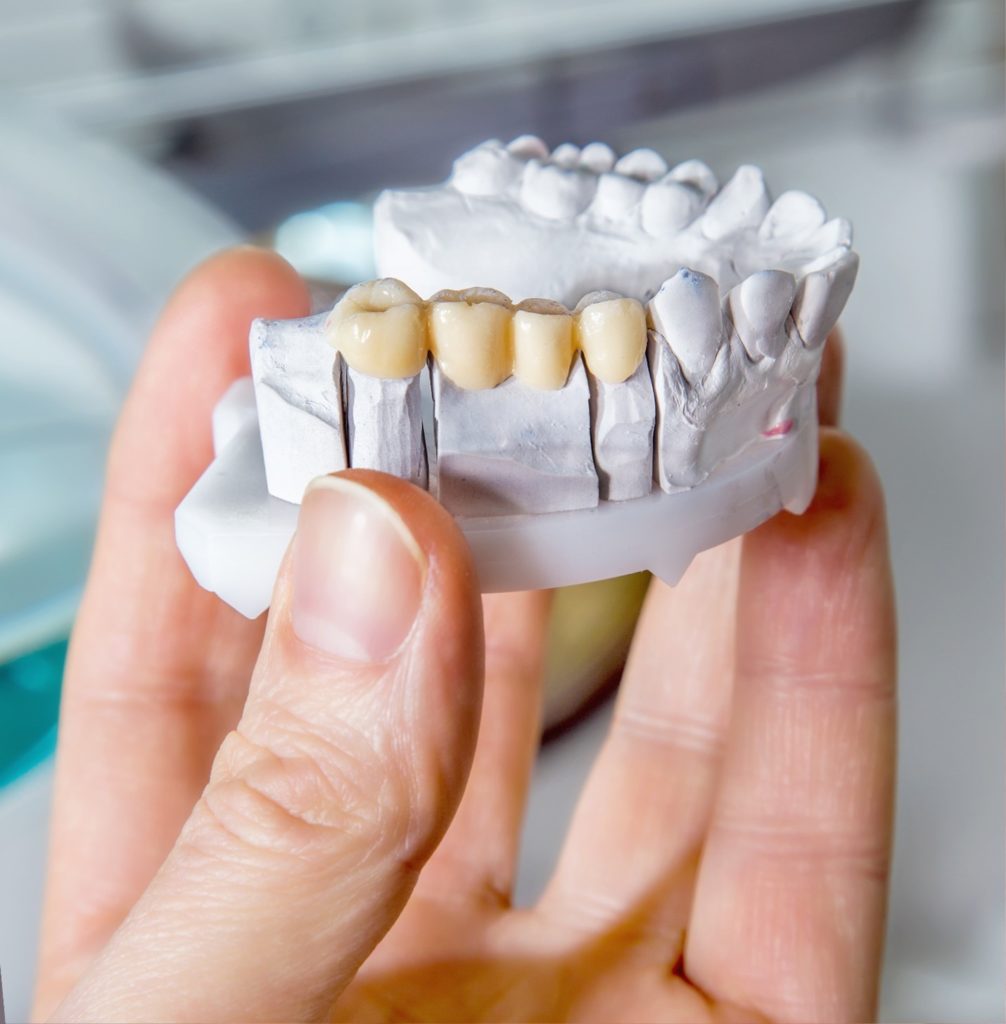 how-long-does-a-dental-bridge-last