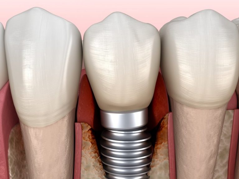 loose-dental-implants-causes-treatments-dr-letelier