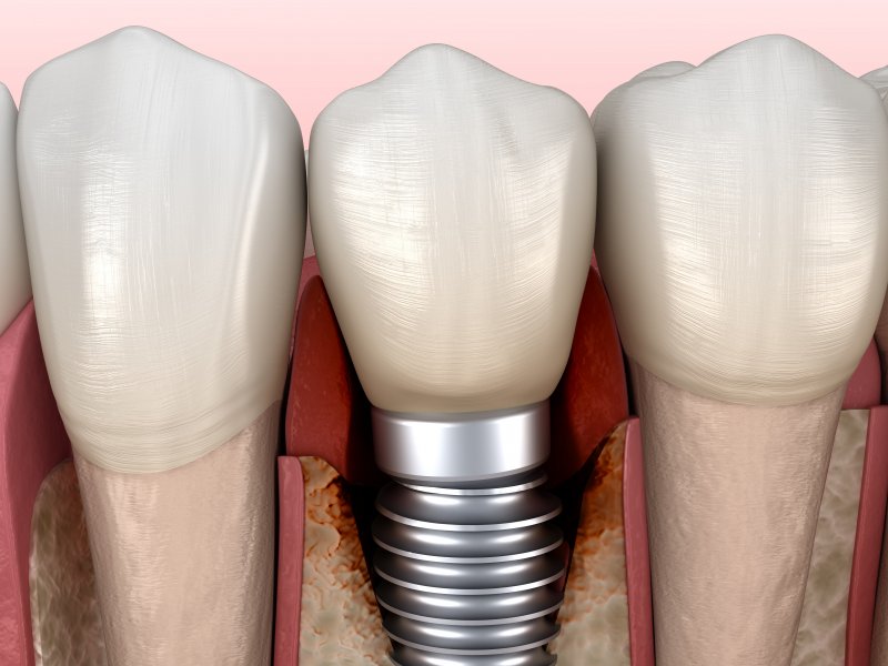 My Dental Implant Feels Loose — What Should I Do?