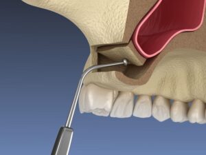 Illustration showing part of sinus lift procedure